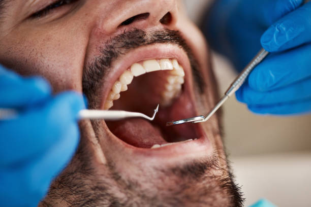 Best Emergency Tooth Extraction in Hollis, OK